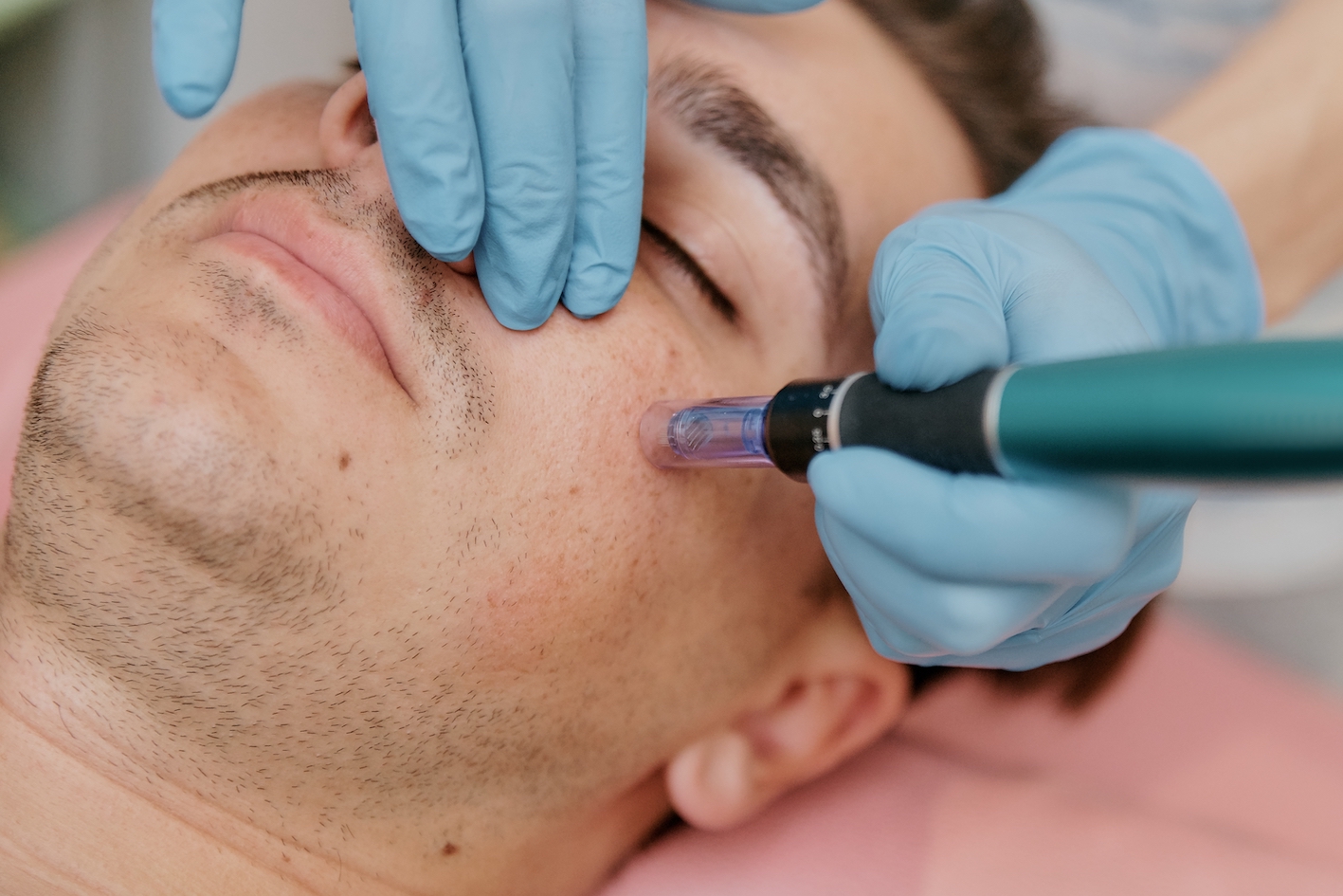 behandeling microneedling