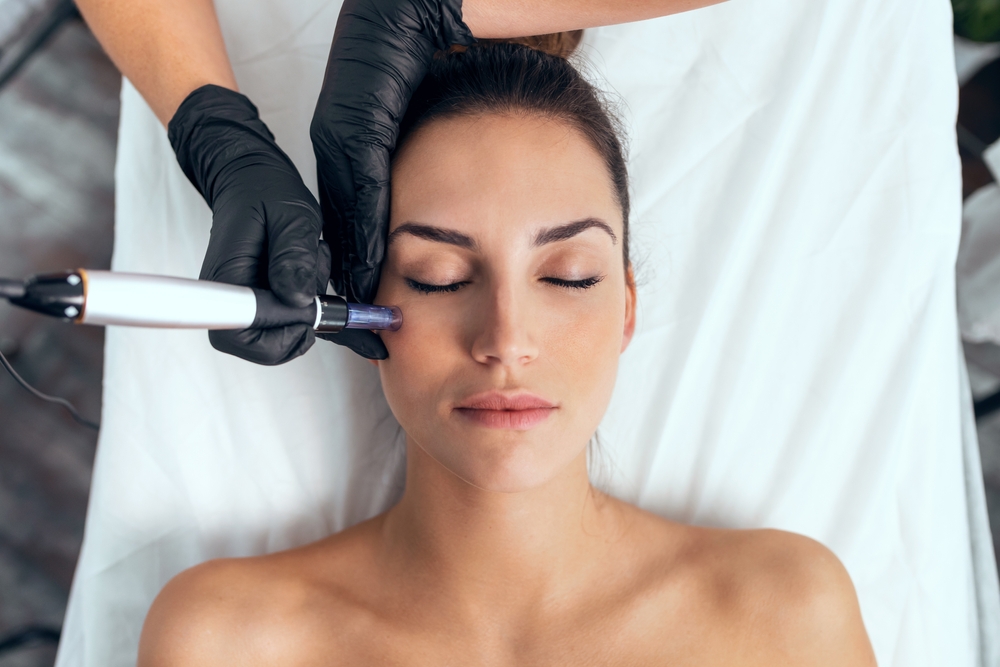 microneedling